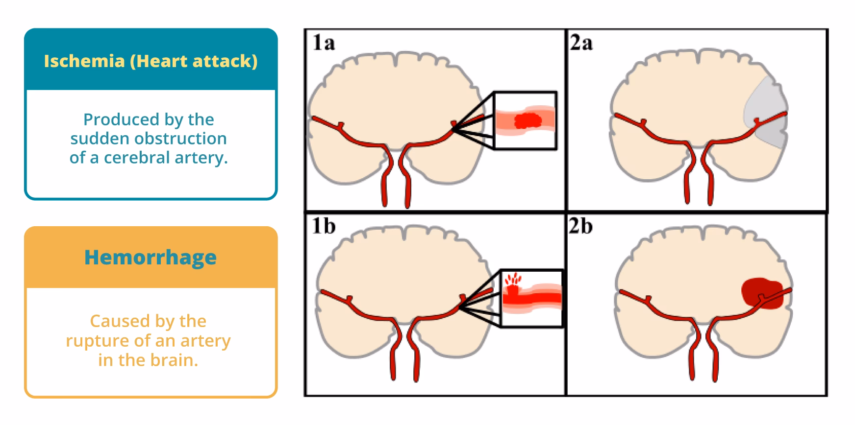 What is the most common cause of a cerebrovascular accident?