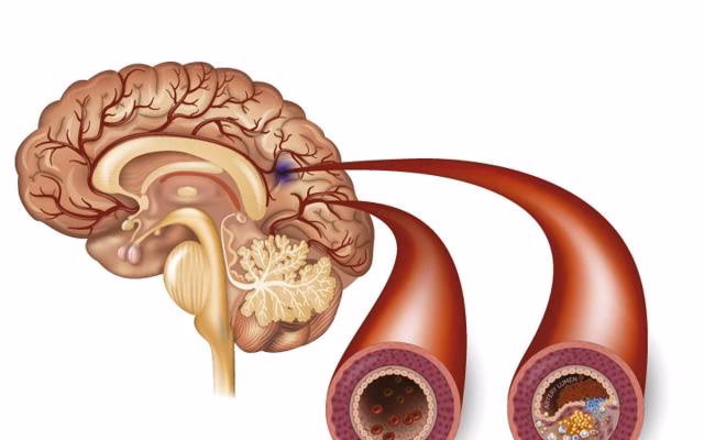 ¿Qué pasa después de una isquemia cerebral?