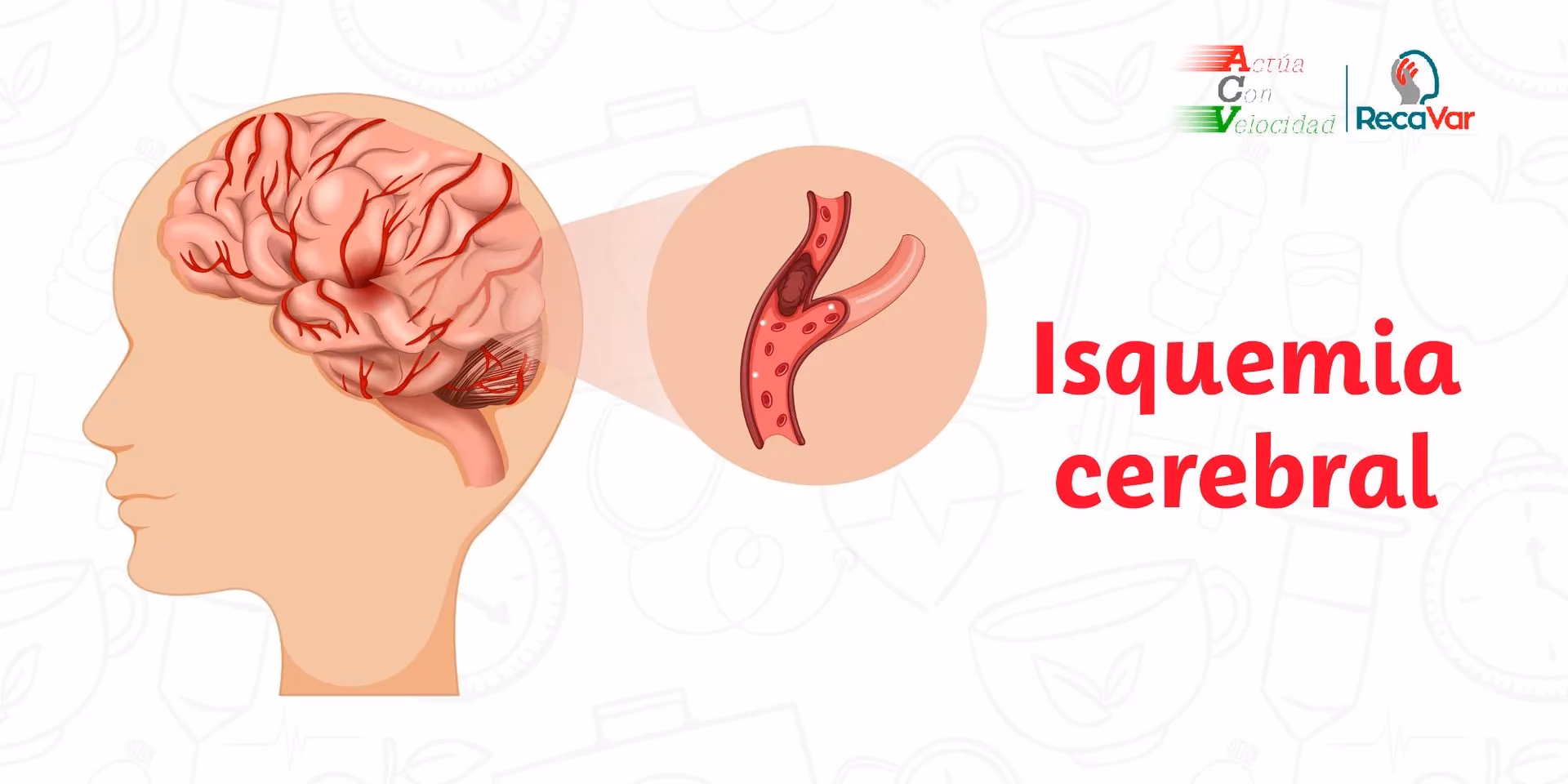¿Qué es la isquemia subaguda?
